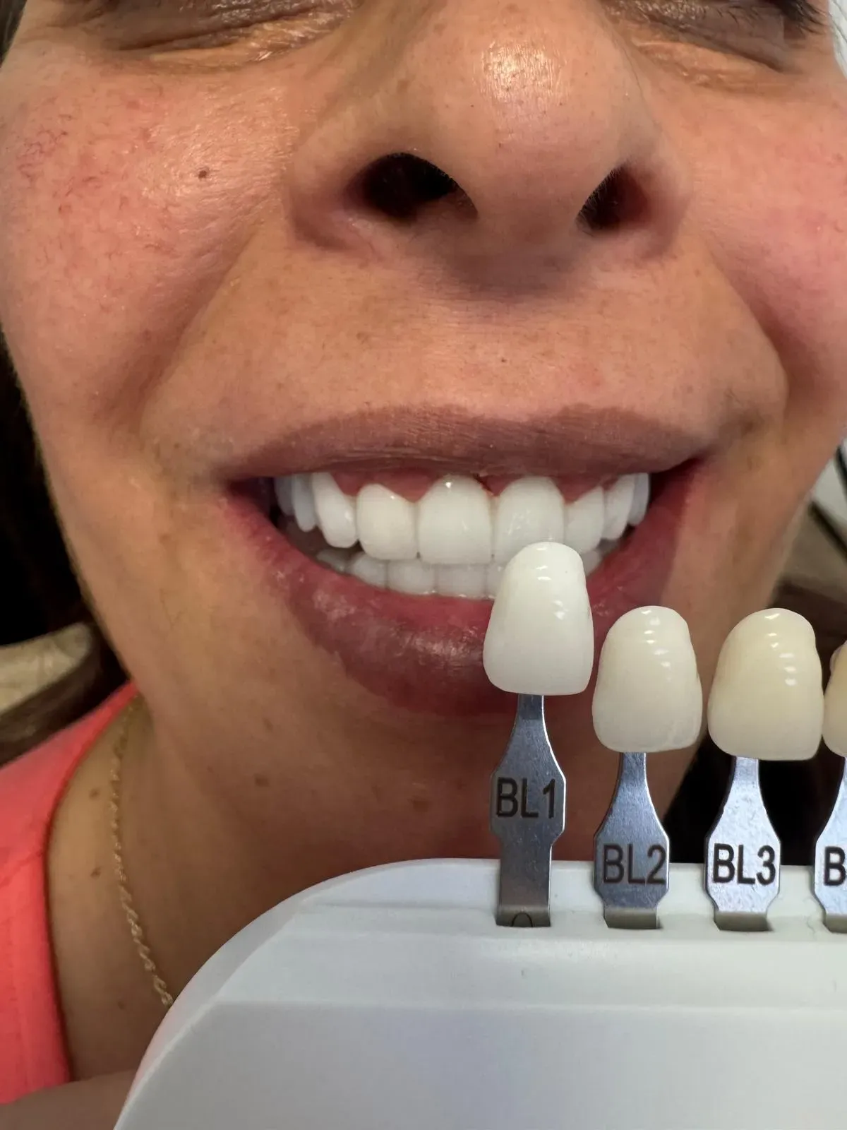 Transformarea Zâmbetului Florentinei: Reabilitare orală complexă prin coroane implanto-purtate și fațetare dentară ceramică